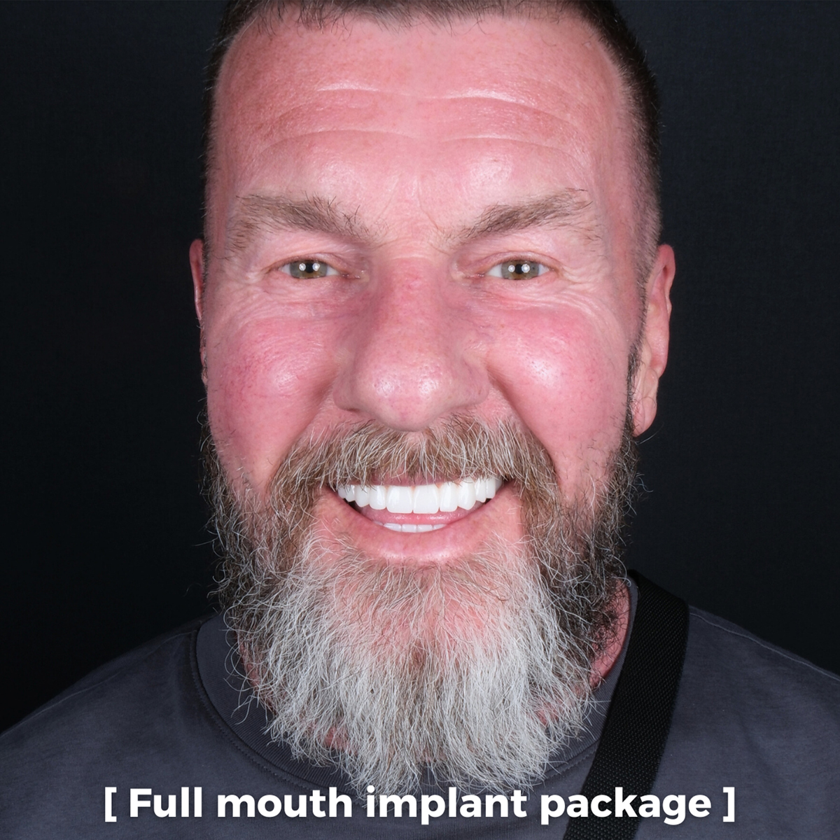 Patient smiling after implants