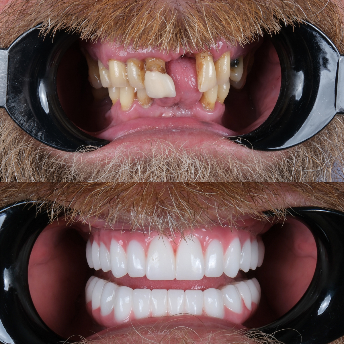 Patient smiling after implants